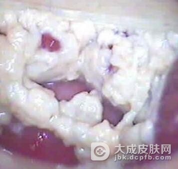 霉菌性阴道炎的原因有哪些