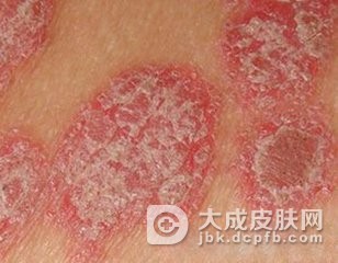 寻常型银屑病应该如何治疗非常好