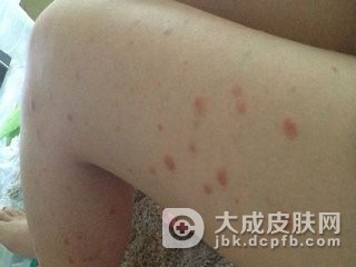 寻常型银屑病怎样才能祛除