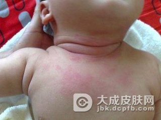 身上长痱子一样的小红点  