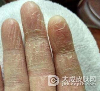 手癣带来的影响有哪些呢