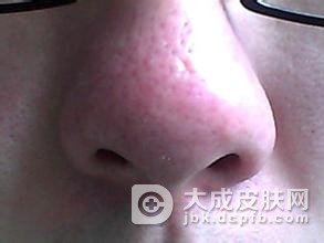 这些食物也可治酒渣鼻