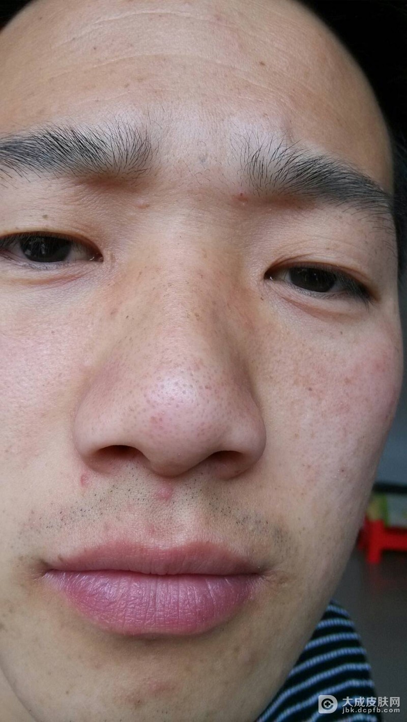 酒渣鼻可能是饮食导致的