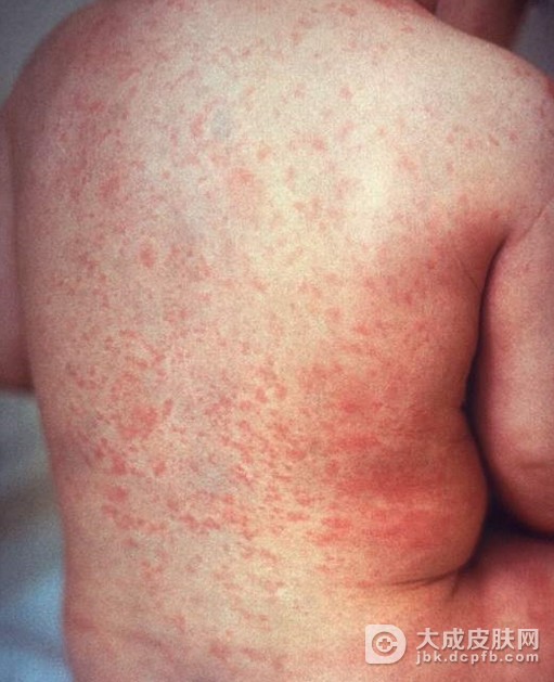 不同时期的麻疹有哪些症状