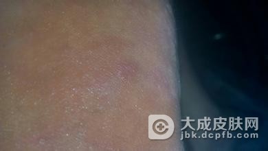药物过敏诱发荨麻疹后怎么快速治愈