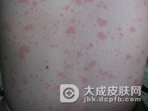 判断药物过敏的方法有什么