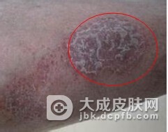 外阴湿疹怎么预防？