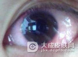 眼睑带状疱疹的表现特征有哪些