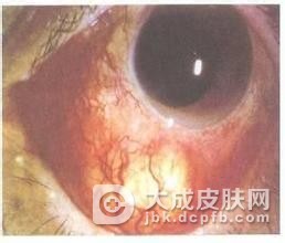 眼睑带状疱疹的常用治疗方法