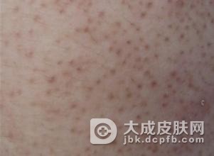 毛囊炎的早期症状是什么