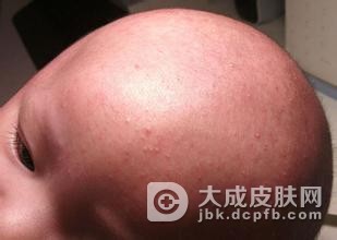 毛囊炎的具体症状你知多少