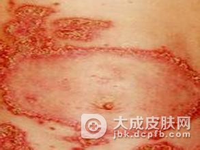 儿童药疹的类型及表现
