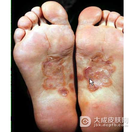 梅毒患者应该做哪些检查项目