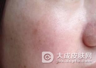 知名专家讲解如何淡化黄褐斑