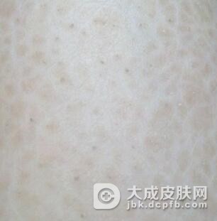 儿童鱼鳞病用什么护肤