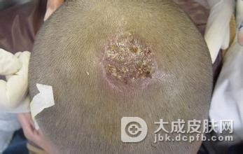 儿童头癣日常护理注意事项