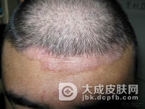 导致头癣加重的原因有哪些