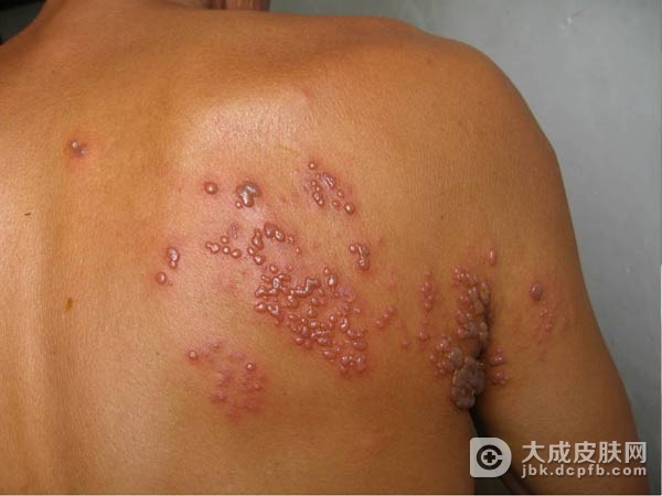 汗疱疹患者日常注意事项是什么