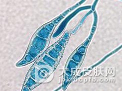 糠秕孢子菌毛囊炎病发的病因是什么？