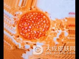 糠秕孢子菌毛囊炎常见的病因是什么