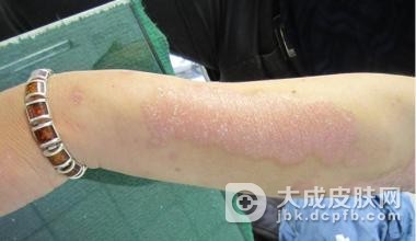 患上银屑病怎么止痒