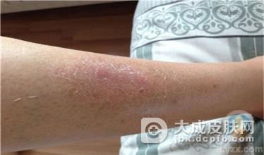 银屑病患者在饮食上要有适当的忌口