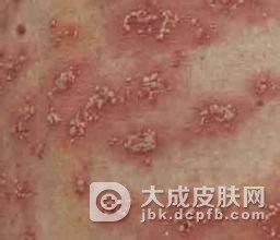 银屑病疾病患病的原因