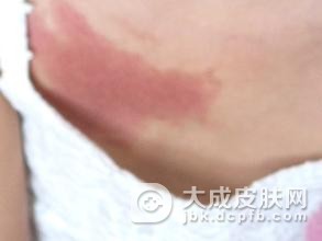 新生儿胎记会自己消失吗