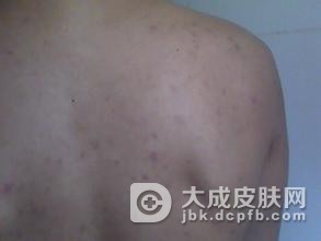 粉刺型痤疮有哪些的影响