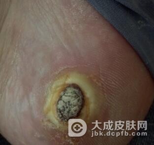 脚底长跖疣怎么治好呢
