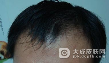 头发出油多还总是脱发是怎么回事