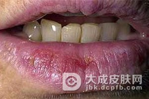 慢性唇炎怎么治疗