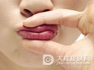 得了唇炎怎么办