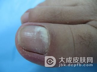 生活中灰指甲有哪些症状