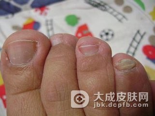 灰脚指甲的治疗方法有哪些