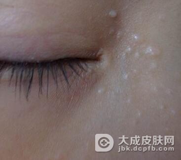 毛发上皮瘤这个疾病应该怎么样鉴别诊断呢