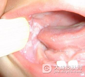 小儿脓窠疮的症状有哪些