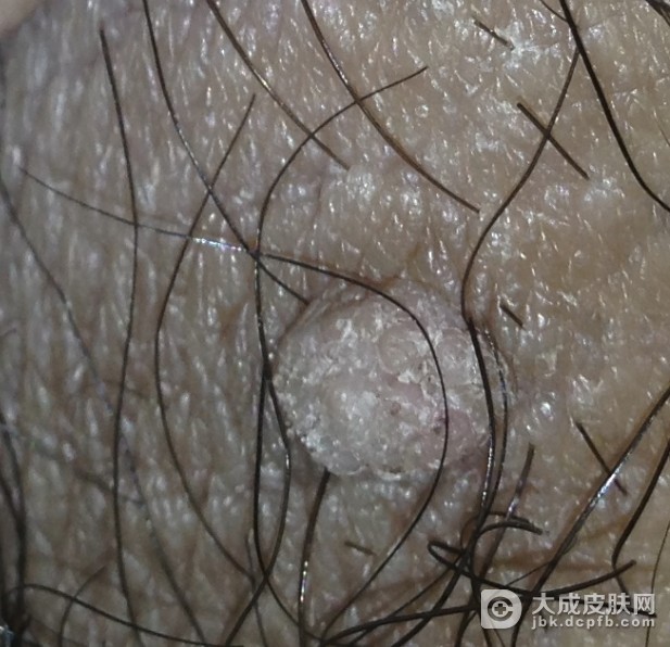 湿疹样癌的症状有哪些