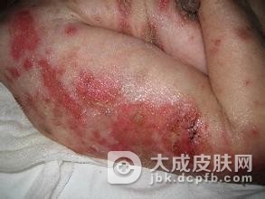家族性良性慢性天疱疮的病因病机