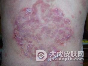 家族性慢性良性天疱疮的致病因素
