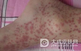 小儿过敏性紫癜的饮食治疗方法
