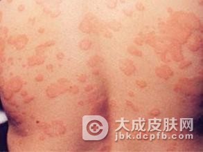压迫性荨麻疹要注意什么