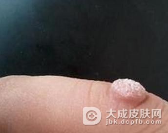 疣状表皮发育不良的知识