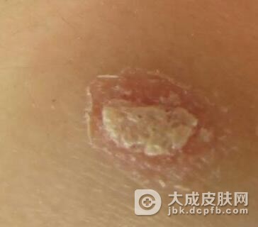 增殖性皮炎疾病的知识
