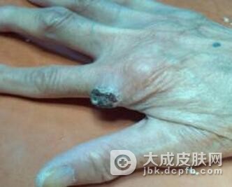 该怎么样预防职业性皮肤癌
