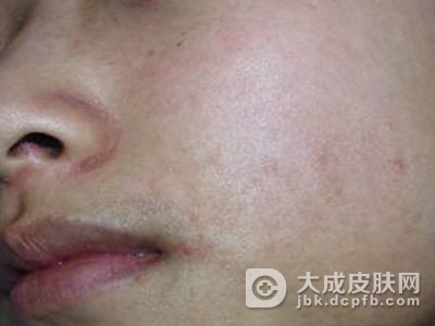 面颈部毛囊性红斑黑变病如何鉴别诊断