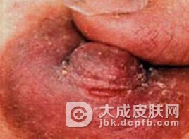 乳头炎和乳晕炎的检查项目有哪些