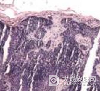 得了透明细胞汗腺腺瘤怎么办