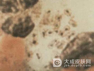 腹股沟肉芽肿不同性别有不同症状