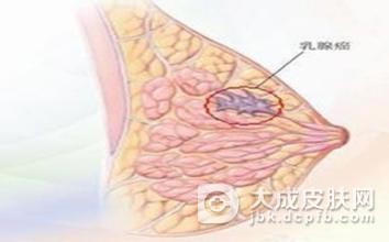 生乳头汗管囊腺瘤应该如何预防